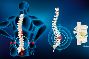 Hernia Discal Hernia Discal
